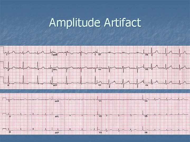 Amplitude Artifact 