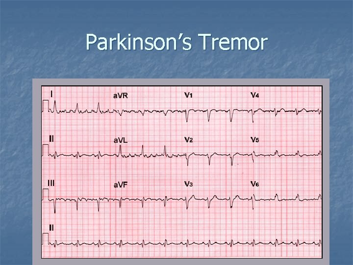 Parkinson’s Tremor 
