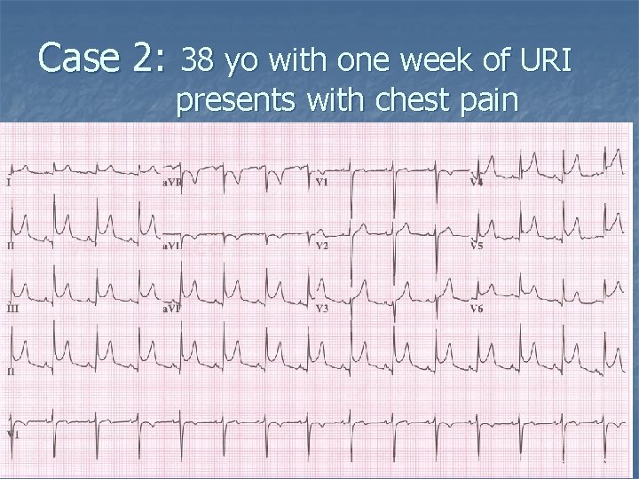 Case 2: 38 yo with one week of URI presents with chest pain 