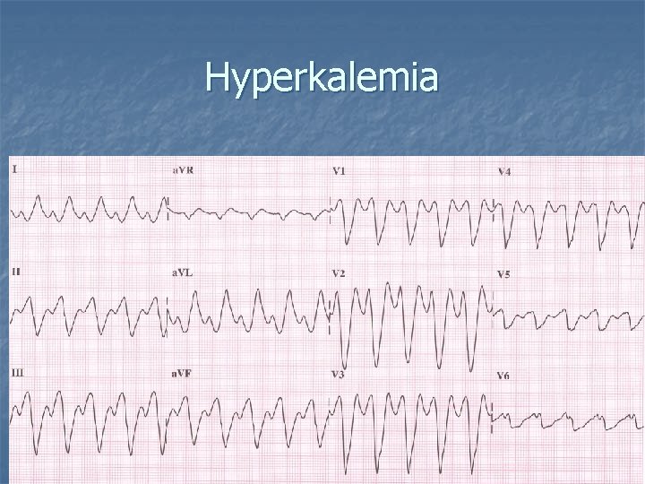 Hyperkalemia 