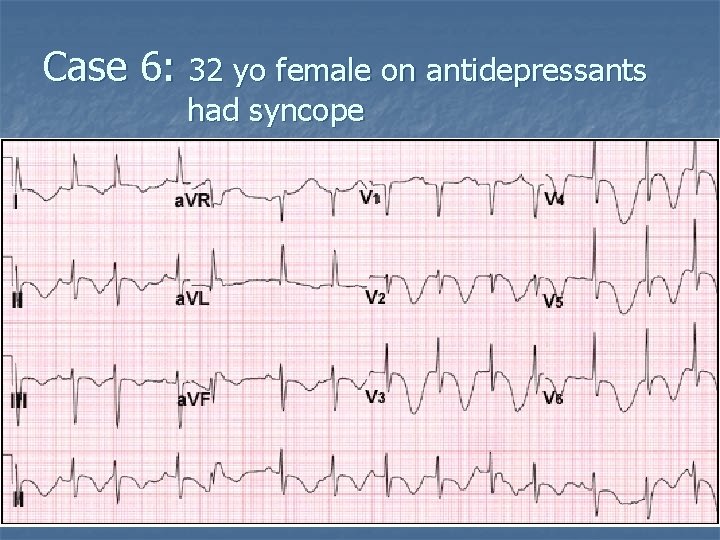 Case 6: 32 yo female on antidepressants had syncope 