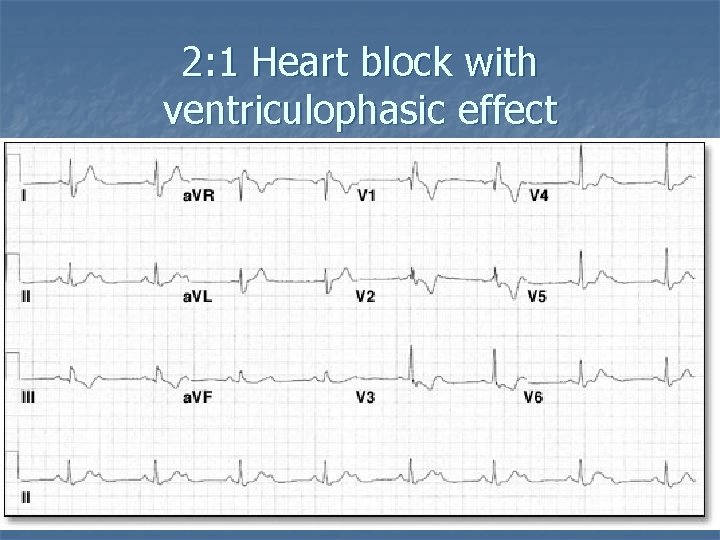 2: 1 Heart block with ventriculophasic effect 