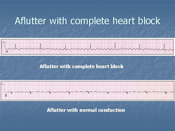 Aflutter with complete heart block Aflutter with normal conduction 