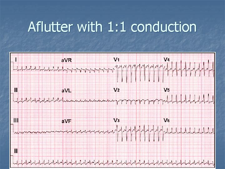 Aflutter with 1: 1 conduction 