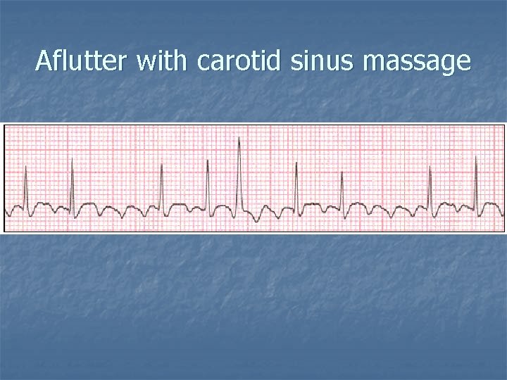 Aflutter with carotid sinus massage 
