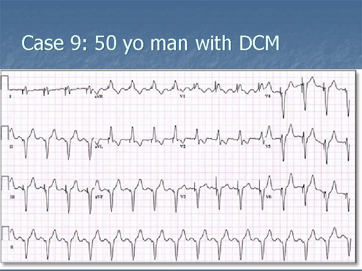 Case 9: 50 yo man with DCM 