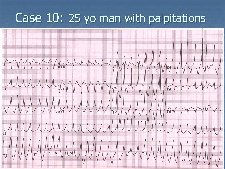 Case 10: 25 yo man with palpitations 
