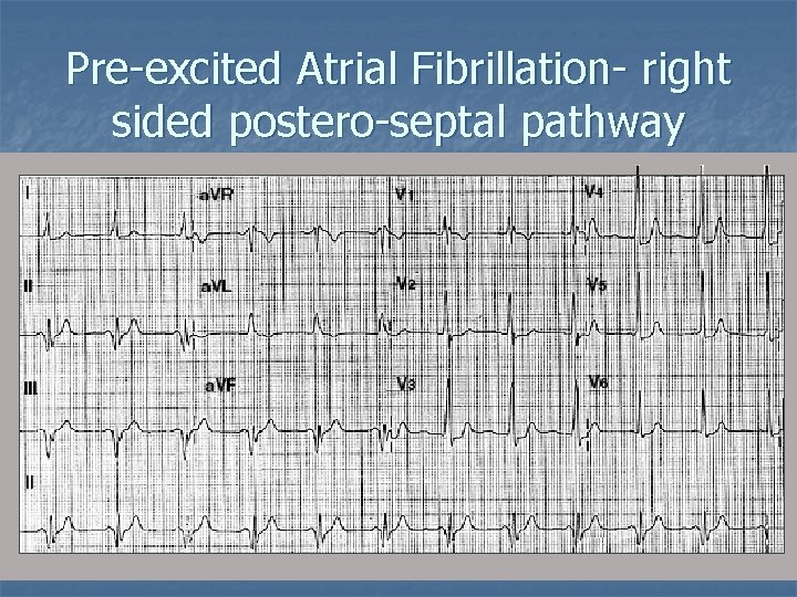 Pre-excited Atrial Fibrillation- right sided postero-septal pathway 