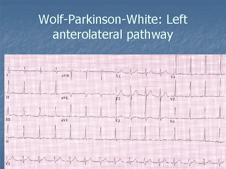 Wolf-Parkinson-White: Left anterolateral pathway 