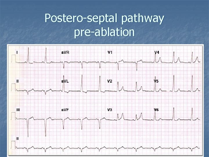Postero-septal pathway pre-ablation 