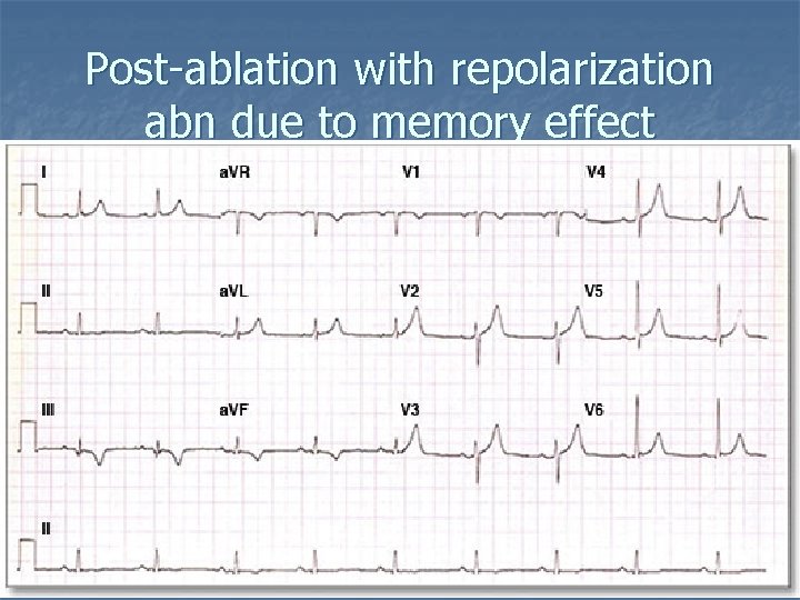 Post-ablation with repolarization abn due to memory effect 