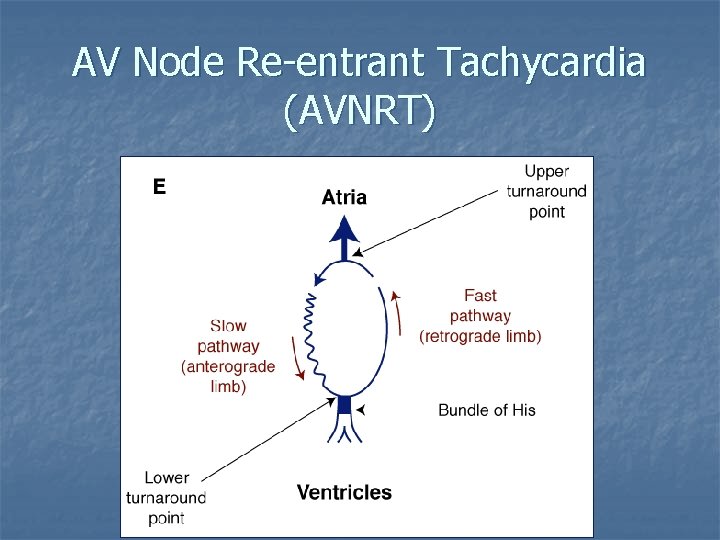 AV Node Re-entrant Tachycardia (AVNRT) 