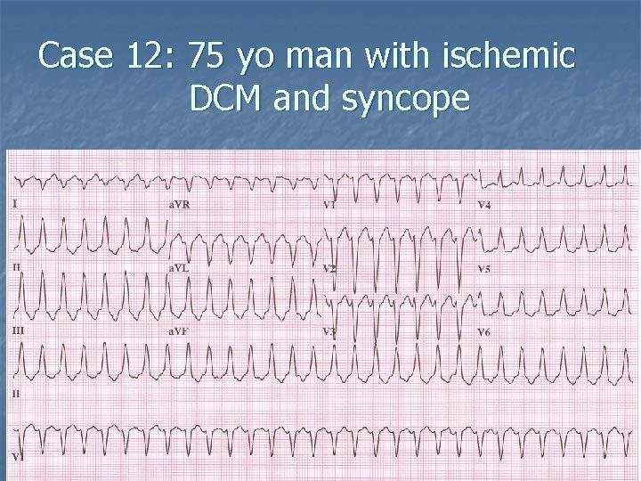Case 12: 75 yo man with ischemic DCM and syncope 