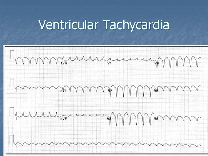 Ventricular Tachycardia 