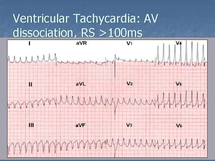 Ventricular Tachycardia: AV dissociation, RS >100 ms 