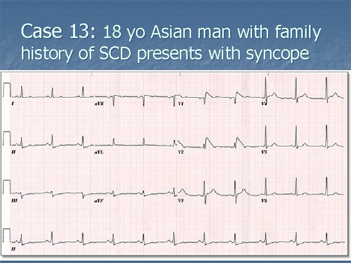 Case 13: 18 yo Asian man with family history of SCD presents with syncope