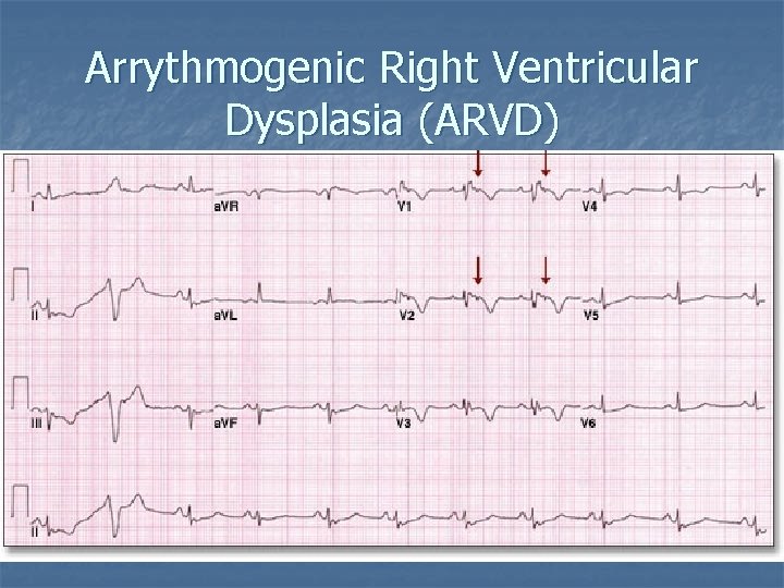 Arrythmogenic Right Ventricular Dysplasia (ARVD) 