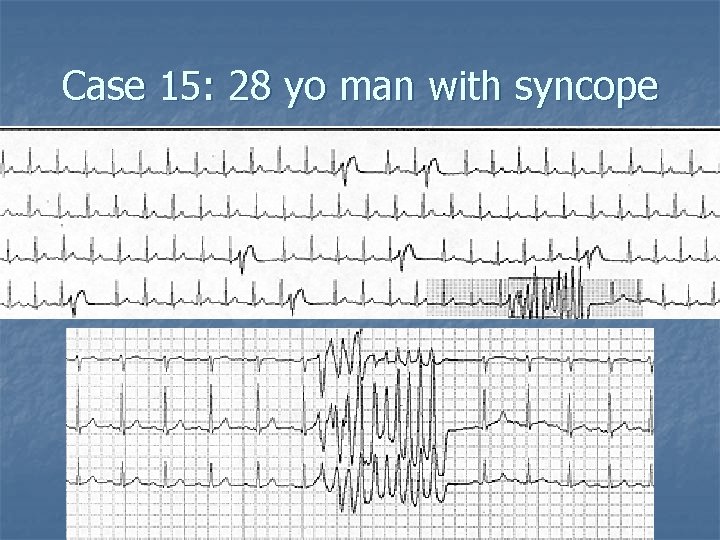 Case 15: 28 yo man with syncope 