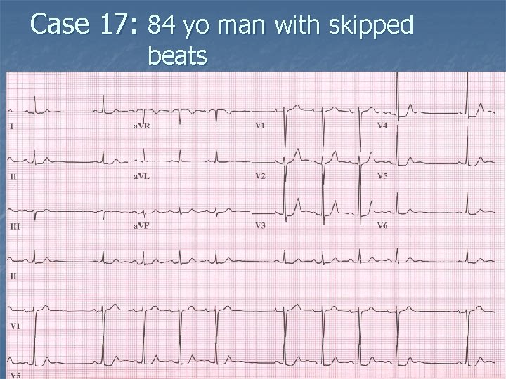Case 17: 84 yo man with skipped beats 