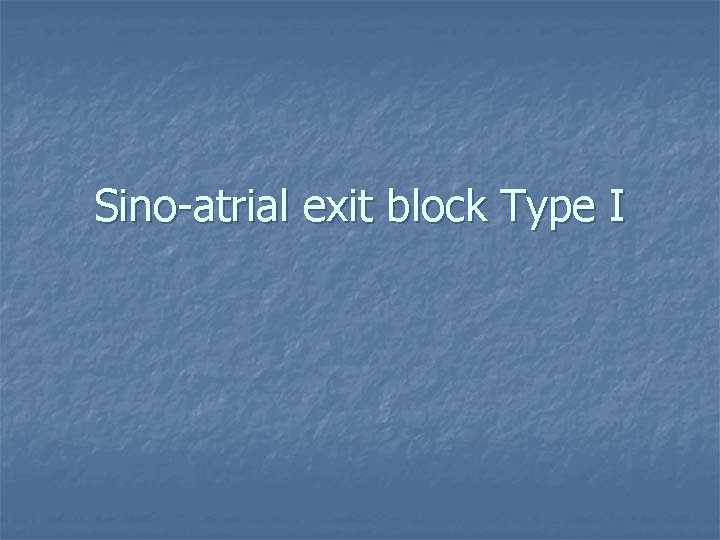 Sino-atrial exit block Type I 