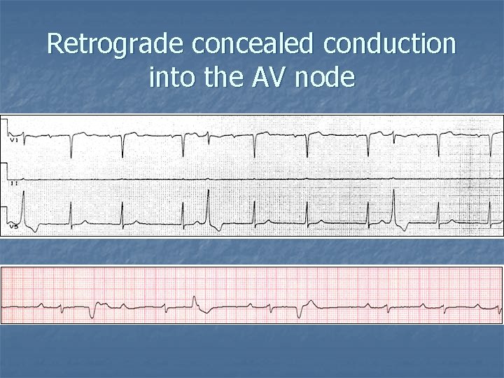 Retrograde concealed conduction into the AV node 