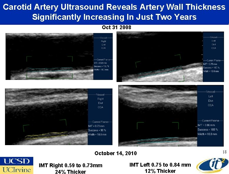 Carotid Artery Ultrasound Reveals Artery Wall Thickness Significantly Increasing In Just Two Years Oct