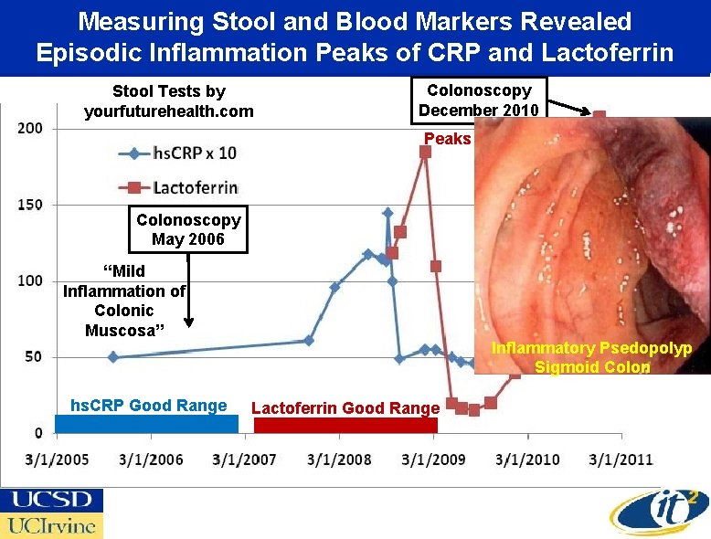 Measuring Stool and Blood Markers Revealed Episodic Inflammation Peaks of CRP and Lactoferrin Stool