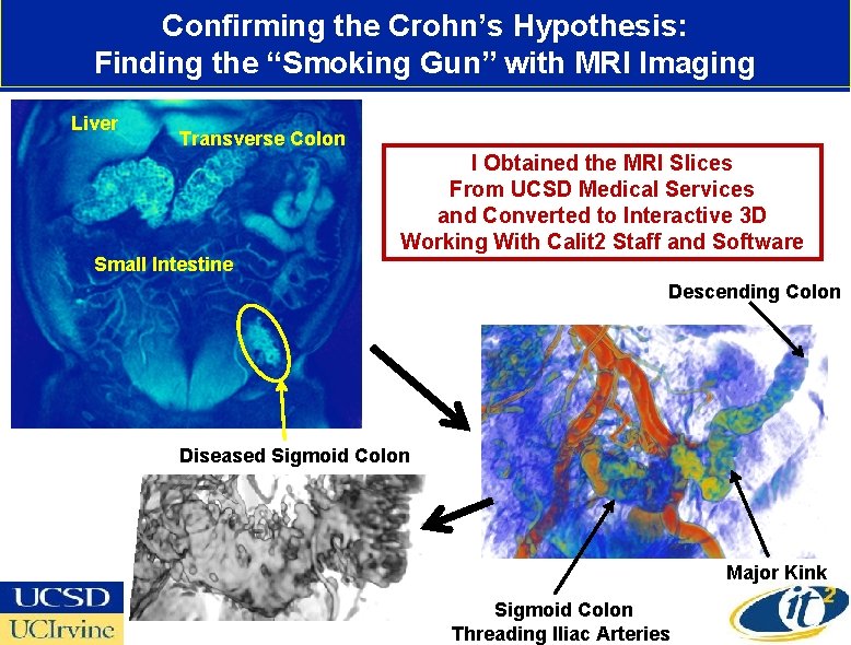 Confirming the Crohn’s Hypothesis: Finding the “Smoking Gun” with MRI Imaging Liver Transverse Colon