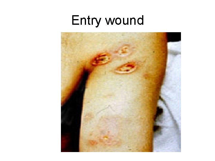 Entry wound 