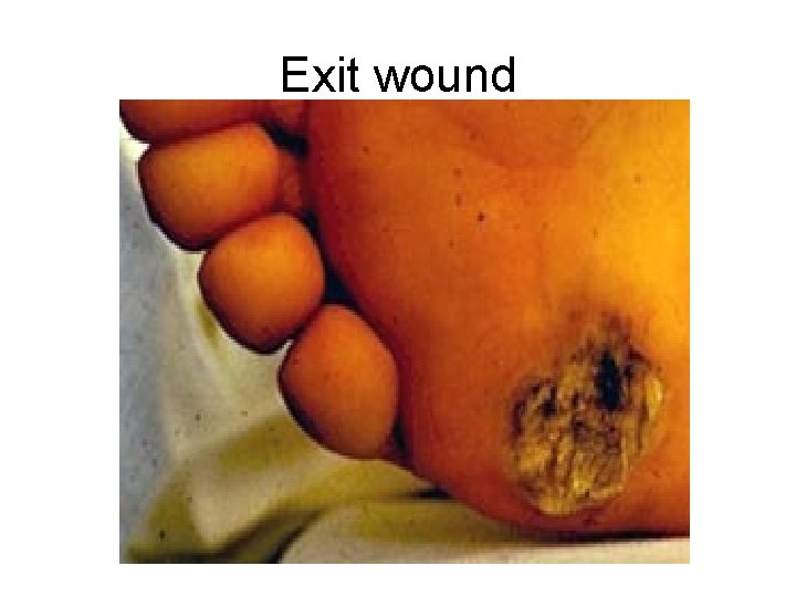 Exit wound 