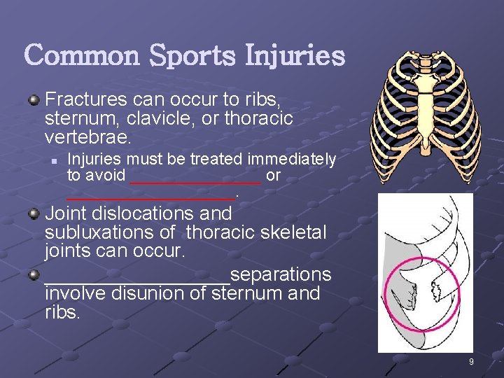 Common Sports Injuries Fractures can occur to ribs, sternum, clavicle, or thoracic vertebrae. n