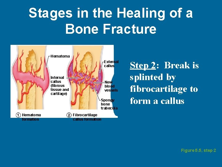 Stages in the Healing of a Bone Fracture Hematoma External callus Internal callus (fibrous