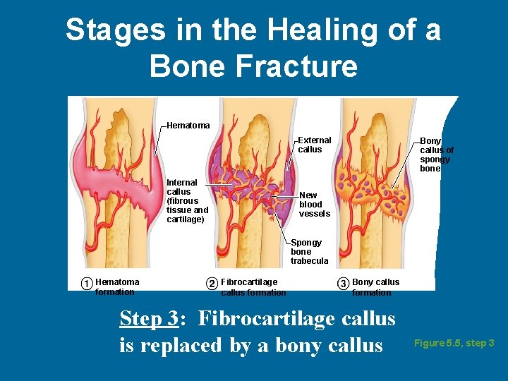 Stages in the Healing of a Bone Fracture Hematoma External callus Internal callus (fibrous