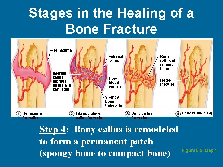 Stages in the Healing of a Bone Fracture Hematoma Internal callus (fibrous tissue and