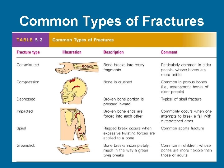 Common Types of Fractures Table 5. 2 