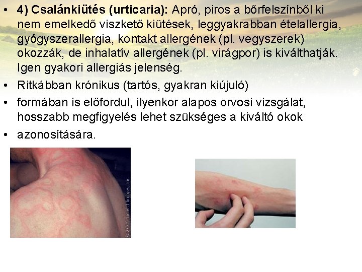  • 4) Csalánkiütés (urticaria): Apró, piros a bőrfelszínből ki nem emelkedő viszkető kiütések,