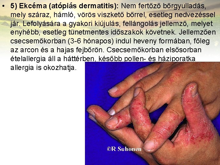  • 5) Ekcéma (atópiás dermatitis): Nem fertőző bőrgyulladás, mely száraz, hámló, vörös viszkető
