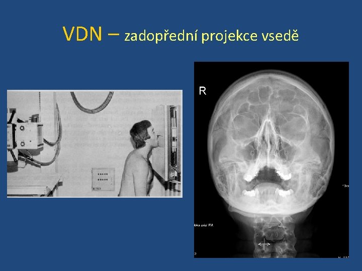 VDN – zadopřední projekce vsedě 