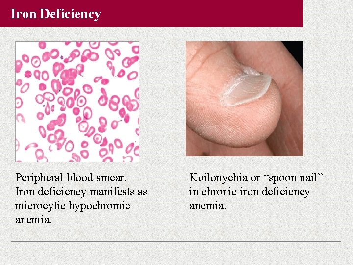 Iron Deficiency Peripheral blood smear. Iron deficiency manifests as microcytic hypochromic anemia. Koilonychia or Iron Deficiency Peripheral blood smear. Iron deficiency manifests as microcytic hypochromic anemia. Koilonychia or