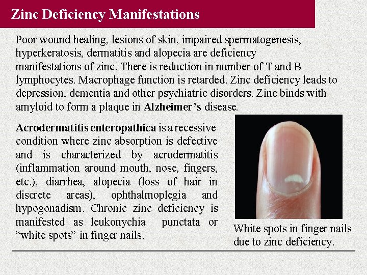 Zinc Deficiency Manifestations Poor wound healing, lesions of skin, impaired spermatogenesis, hyperkeratosis, dermatitis and Zinc Deficiency Manifestations Poor wound healing, lesions of skin, impaired spermatogenesis, hyperkeratosis, dermatitis and