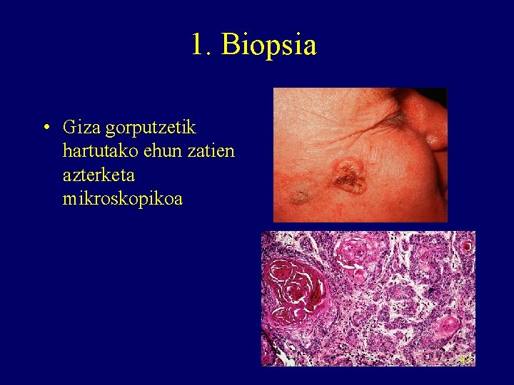 1. Biopsia • Giza gorputzetik hartutako ehun zatien azterketa mikroskopikoa 43 