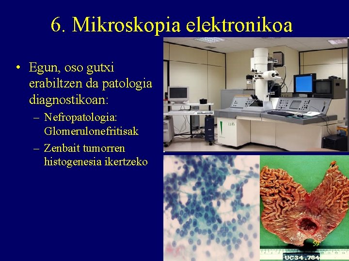 6. Mikroskopia elektronikoa • Egun, oso gutxi erabiltzen da patologia diagnostikoan: – Nefropatologia: Glomerulonefritisak
