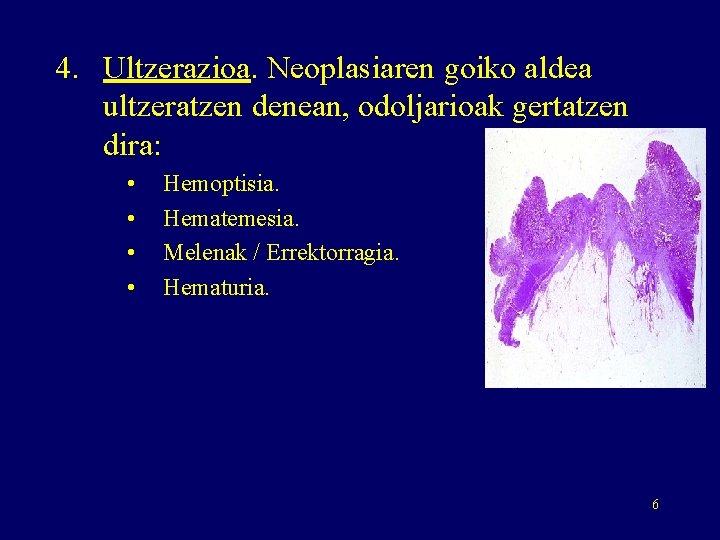 4. Ultzerazioa. Neoplasiaren goiko aldea ultzeratzen denean, odoljarioak gertatzen dira: • • Hemoptisia. Hematemesia.
