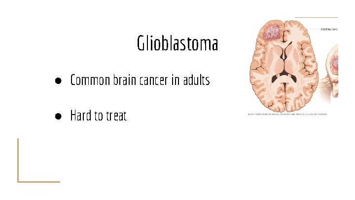 Glioblastoma ● Common brain cancer in adults ● Hard to treat 