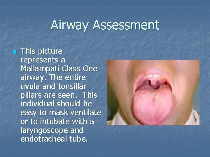 Airway Assessment n This picture represents a Mallampati Class One airway. The entire uvula