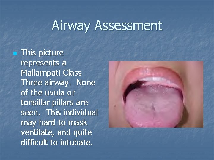 Airway Assessment n This picture represents a Mallampati Class Three airway. None of the