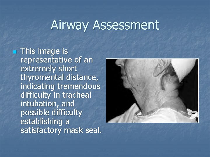 Airway Assessment n This image is representative of an extremely short thyromental distance, indicating