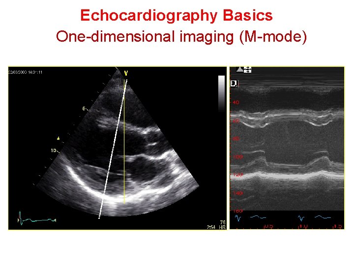 Echocardiography Basics One-dimensional imaging (M-mode) 