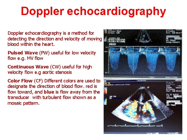 Doppler echocardiography is a method for detecting the direction and velocity of moving blood