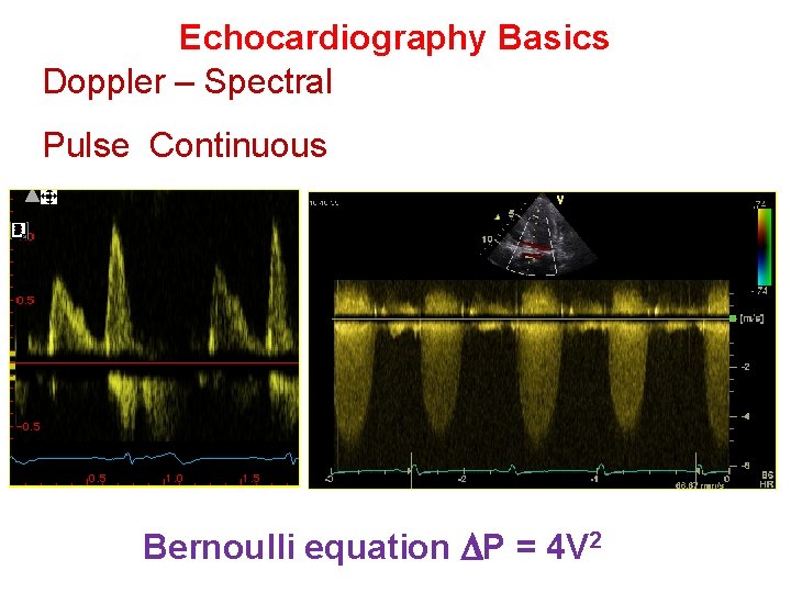 Echocardiography Basics Doppler – Spectral Pulse Continuous Bernoulli equation P = 4 V 2